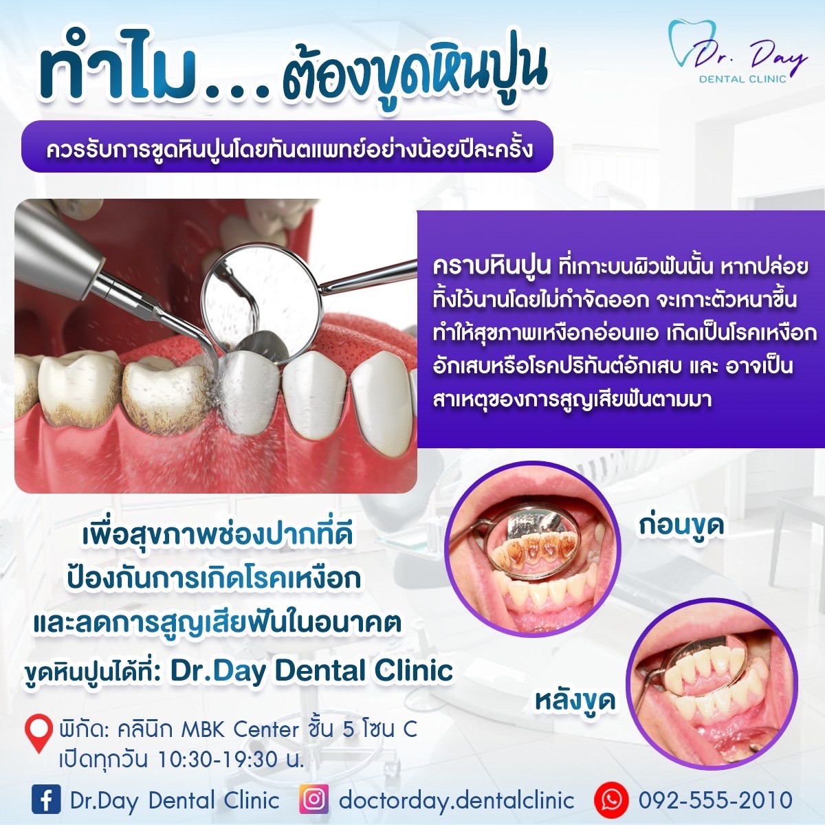 ขูดหินปูน